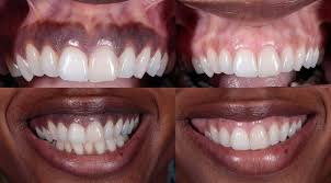 dark gums 5 discoloration reasons and