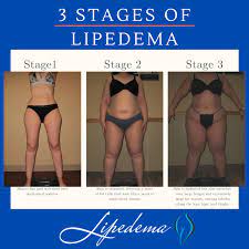 lipedema treatment