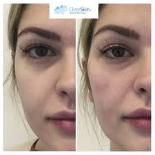 Fillers work best for areas in the middle and lower third of the face. Facial Fillers Clearskin