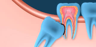 In most cases, wisdom teeth are removed before they erupt. Oral Surgery Affordable Wisdom Tooth Extraction Dr Sonia Sharma