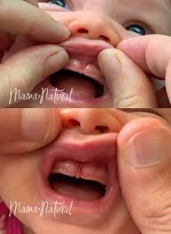 lip tie how to check your baby and