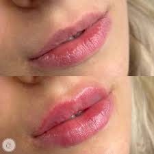 lip fillers beautifully shaped y
