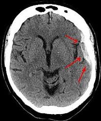 Subdural hematoma (sdh) develops due to rupture of the bridging veins on the surface of the brain. Subdural Hematoma Wikipedia