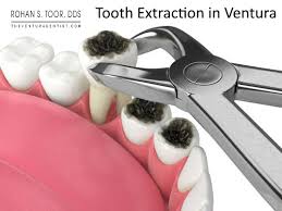 ventura tooth extraction cost do i