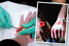 Maybe you would like to learn more about one of these? Iron Man Hand Craze Horrific Video Won T Make You Want To Look Like A Superhero Daily Star