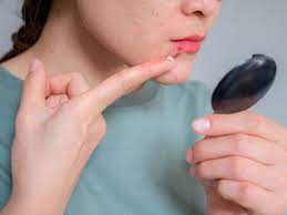 can psoriasis affect your lips