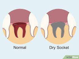 How long after wisdom teeth removal can i drink coffee and alcohol well, for some people, starting or ending a day without caffeine is almost impossible. 4 Ways To Prevent Dry Socket After A Tooth Extraction Wikihow