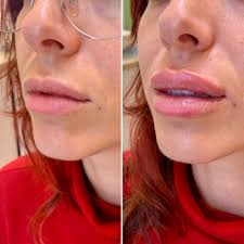 lip fillers for thin lips dermal