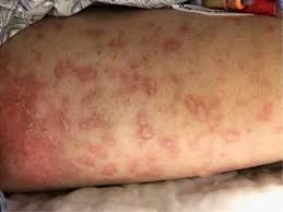 skin infections springerlink