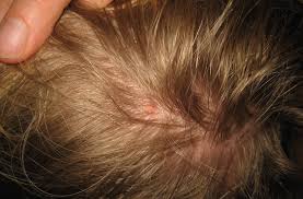 how to get rid of lice insight pest