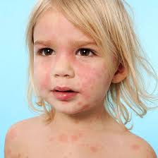 causes and cures of rashes