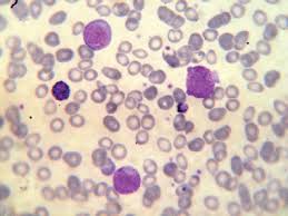 A Case Of Chronic Myeloid Leukaemia Presenting As Megakaryocytic
