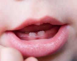 Как правило во время прорезывания зубов малыши испытывают дискомфорт, который значительно влияет на нервную систему ребенка и заставляет родителей изрядно волноваться. Sroki Prorezyvaniya Molochnyh Zubov U Detej Semejnyj Stomatologicheskij Centr