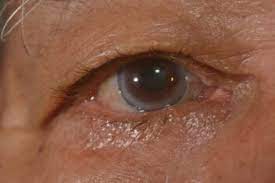 corneal arcus causes treatment