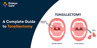 a complete guide to tonsillectomy