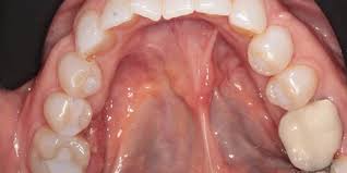 gum graft surgery in gilbert az