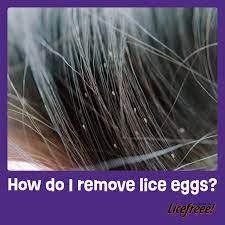 how do i remove lice eggs licefreee
