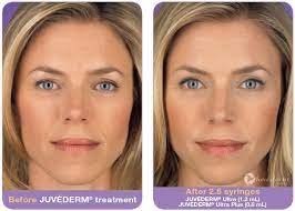 improve your face with juvéderm fillers