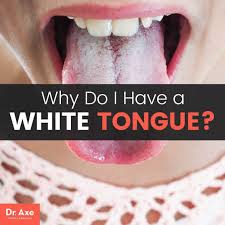 natural treatments for white tongue