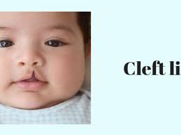 cleft lip causes of cleft lip