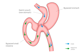 one anastomosis gastric byp