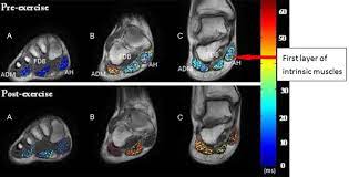 Routine ankle magnetic resonance imaging (mri) tests involve taking images of the foot the mri machine uses radio wave energy pulses and a magnetic field to produce the foot and ankle images. Representative T 2 Values Within Foot Muscles In The Axial Plane Download Scientific Diagram