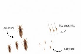 vinegar kill lice or loosen nits