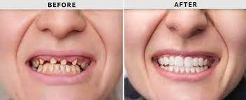 full mouth reconstruction with implants