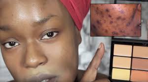 cover acne scars dark skin