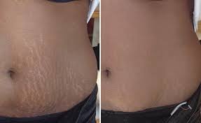 stretch mark tattoo camouflage in