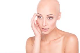 But it can be treated and hair can grow back. Alopecia Thomsen Photography