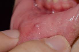 mucocele mucous cyst types symptoms