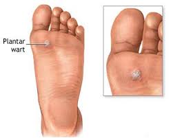 plantar warts barrhaven foot care