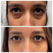 surgery non surgical eyelid lift