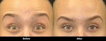 fix droopy eyelids after botox
