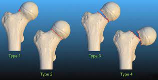 fem neck stress fractures