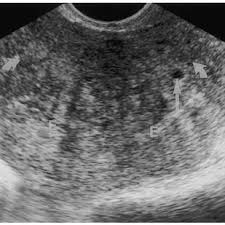 normal uterus on endoinal sonography