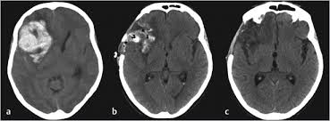 If it's described, i know the different key words (biconcave disk, crescent shaped ect) but i dont know how to distinguish them on ct. 10 Epidural Hematoma Evacuation Subdural Hematoma Evacuation Intracerebral Hemorrhage Evacuation Neupsy Key