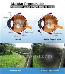 what can cause wavy lines in vision