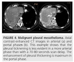 When a ct scan is performed, patients may also undergo a pet scan. Diagnostic Imaging And Workup Of Malignant Pleural Mesothelioma