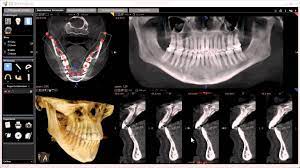 ct scans of the tmj