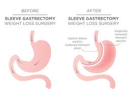 gastric byp surgery riverhead ny