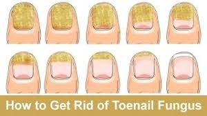 how to get rid of toenail fungus fast