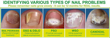 nail psoriasis vs fungus causes