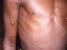 Explainer: What is monkeypox and where ...