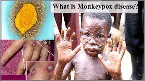 Monkeypox Virus Outbreak: What is ...