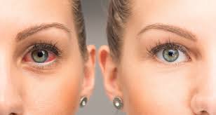 glaucoma drops and eye redness laura