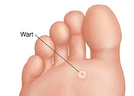 plantar warts and your child s feet