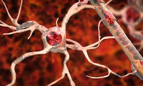 neuron damage from als reversed with
