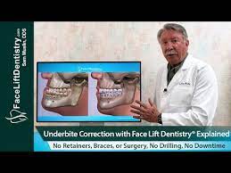 How do you fix an underbite without surgery? Underbite Correction Without Surgery No Braces No Aligners